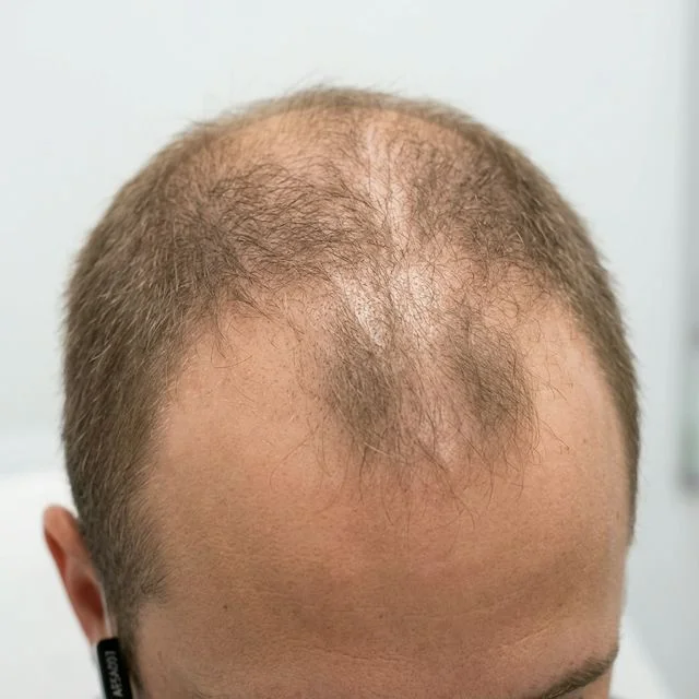 Vorher: Haarausfall bei Patient M.K.